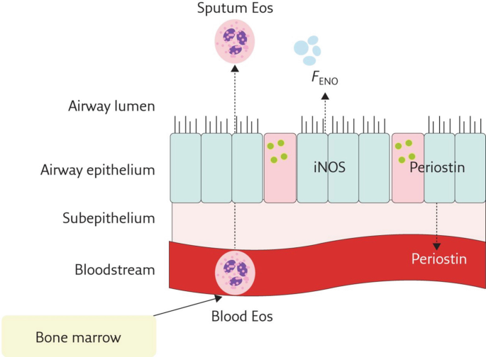 Asthma Phenotypes | Springer Nature Link