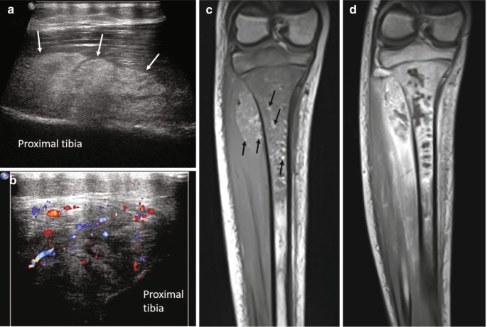 Imaging of Pyogenic Osteomyelitis | Springer Nature Link