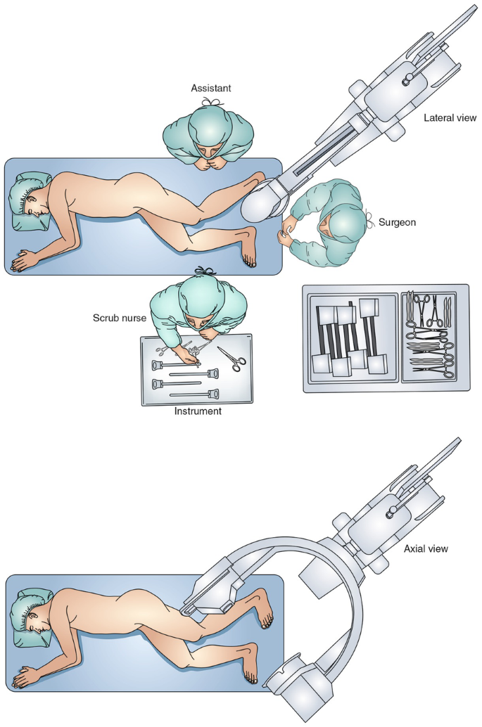 Talus and Calcaneal Fracture Fixation | Springer Nature Link