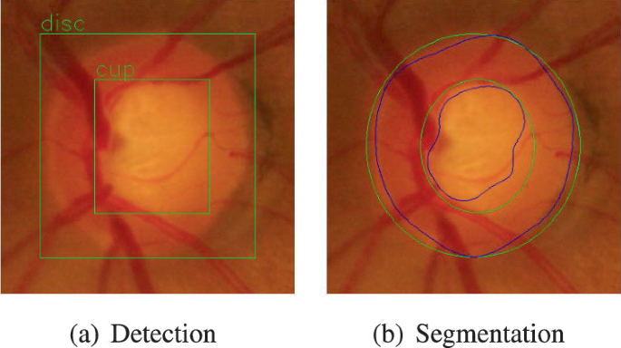 Optic Disc and Optic Cup Image Segmentation for Glaucoma Detection ...