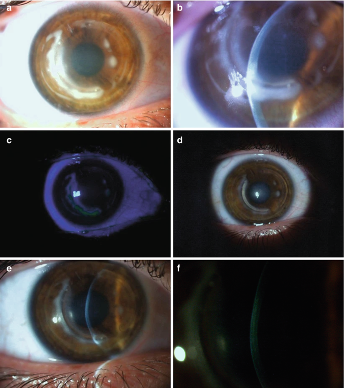 Marginal Infiltrates Marginal Sterile Corneal Infiltrates After LASIK and Corneal Procedures ...