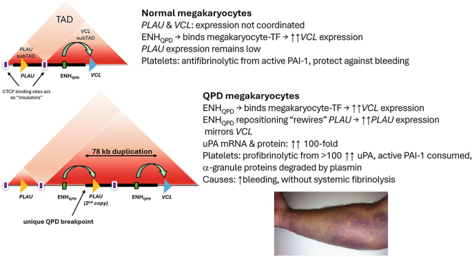 Inherited Platelet Function Disorders: Quebec Platelet Disorder ...
