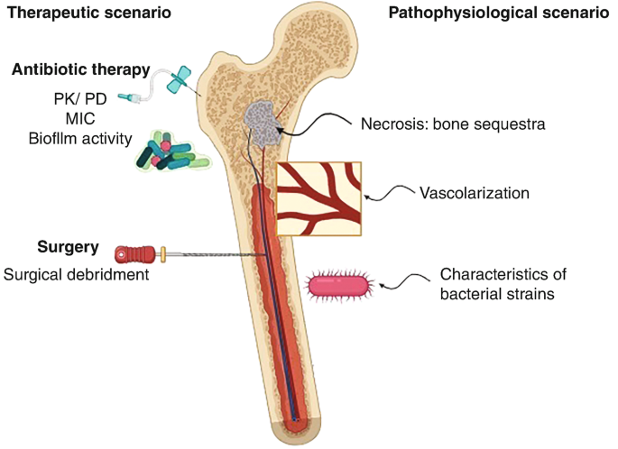 Optimizing Antibiotic Treatment of Bone and Joint Infections ...