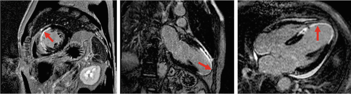 Role of Cardiovascular Magnetic Resonance Imaging in Heart Failure ...