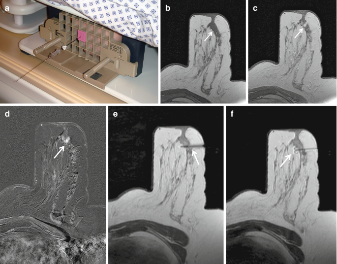 MR-Guided Breast Intervention | Springer Nature Link