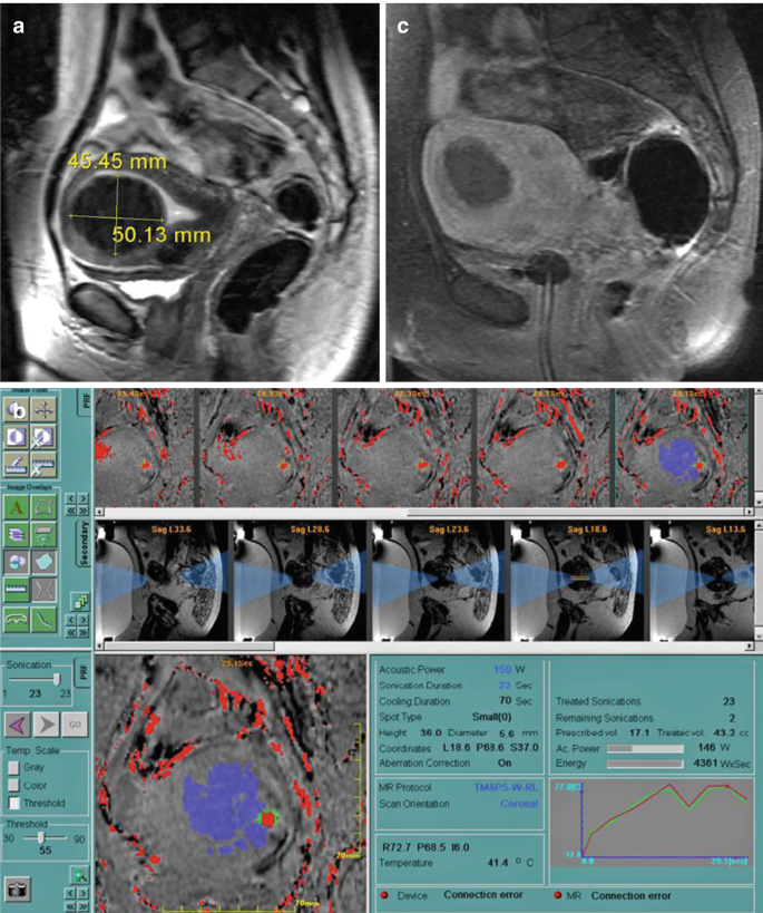 Mri Text MR-Guided High-Intensity Focused Ultrasound (MRgFUS) | Springer Nature Link