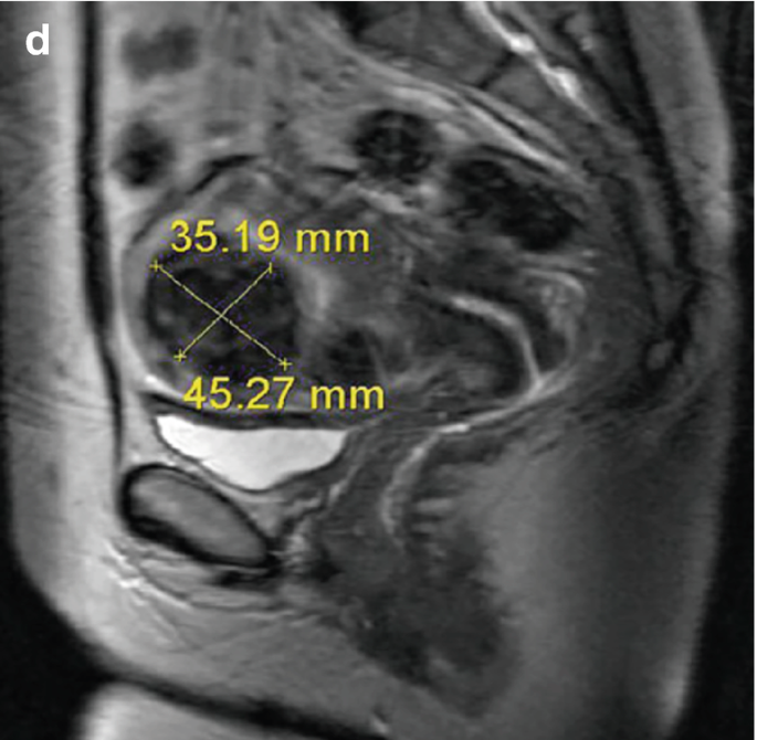 MR-Guided High-Intensity Focused Ultrasound (MRgFUS) | Springer Nature Link