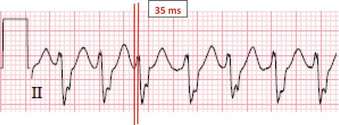 ECG 18 | SpringerLink