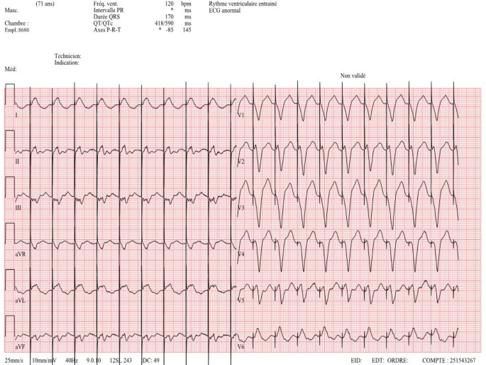 ECG 22 | SpringerLink