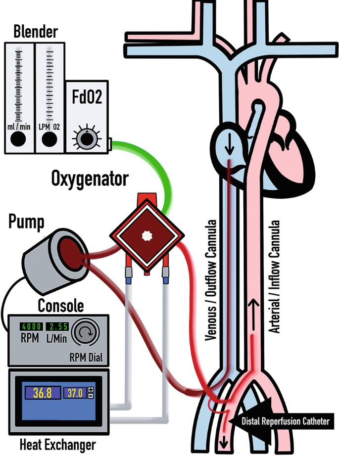 Parts Of Ecmo Circuit