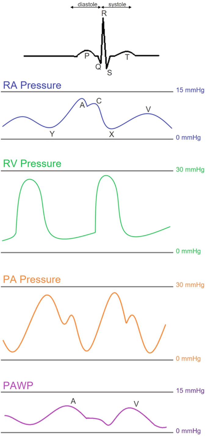 Ra Waveform Rhc Hemodynamic Assessment: Right Catheterization | Springer Nature Link