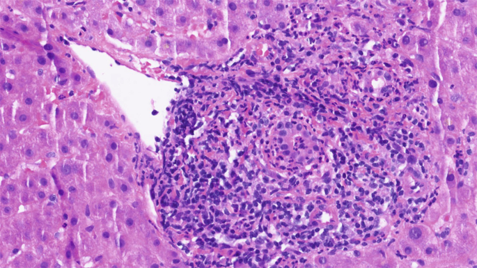 glutathione neuroendocrine pathology The historical background of hereditary cystatin C amyloid angiopathy: Genealogical, pathological, and clinical manifestations - Snorradottir - 2025 - Brain Genetic alterations in gastric amphicrine