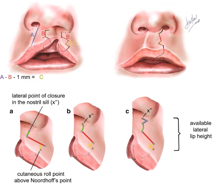 Cleft Lip and Palate | SpringerLink