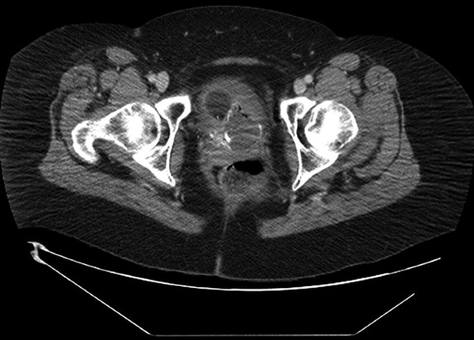 Periurethral Bulking Agent Injection | SpringerLink