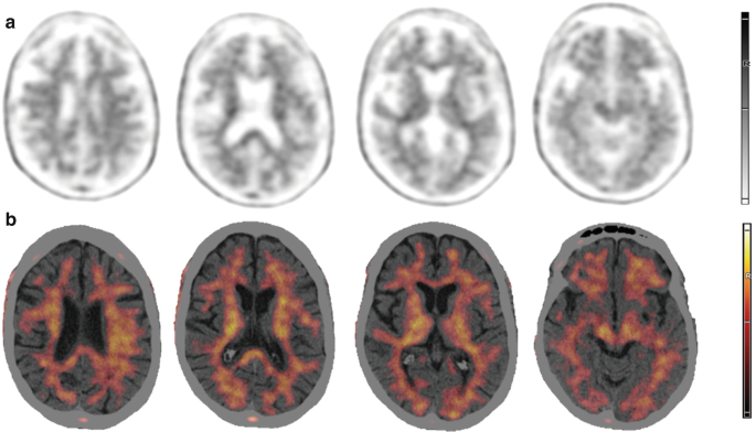 Case 20: Corticobasal Syndrome: [18F]FDG and Amyloid PET | Springer ...