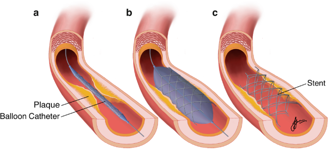 Percutaneous Coronary Intervention (PCI)/Stenting | Springer Nature Link