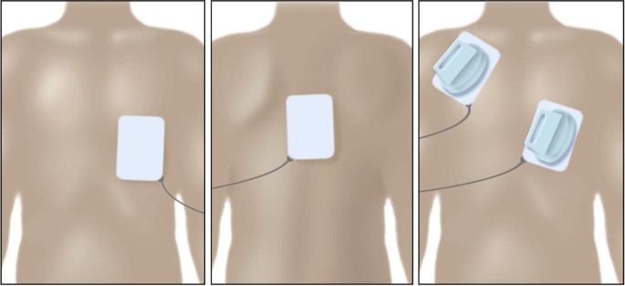 Cardioversion and Defibrillation | Springer Nature Link