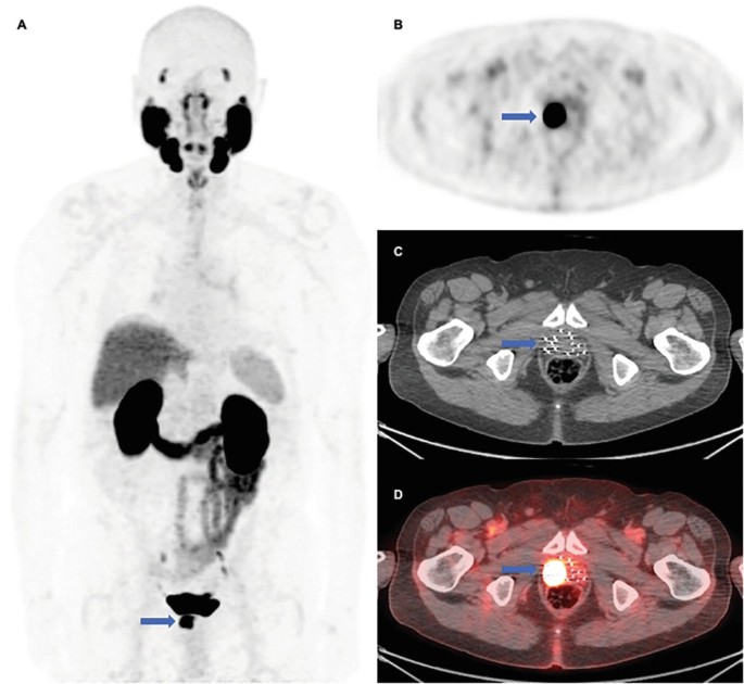 Pet Scan Structure PET Imaging in Clinical Oncology | SpringerLink