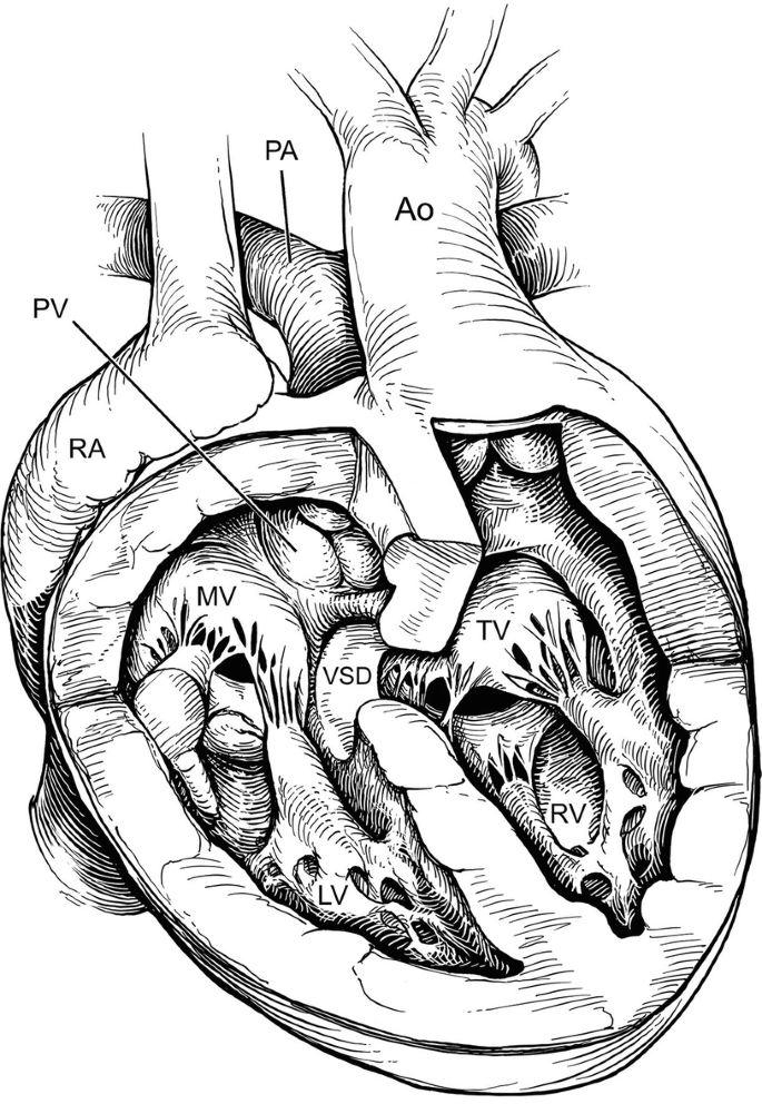 Complications Associated with Repair of Congenitally Corrected ...