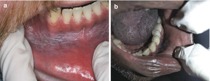 smokeless tobacco diseases Smokeless Tobacco and Oral Health