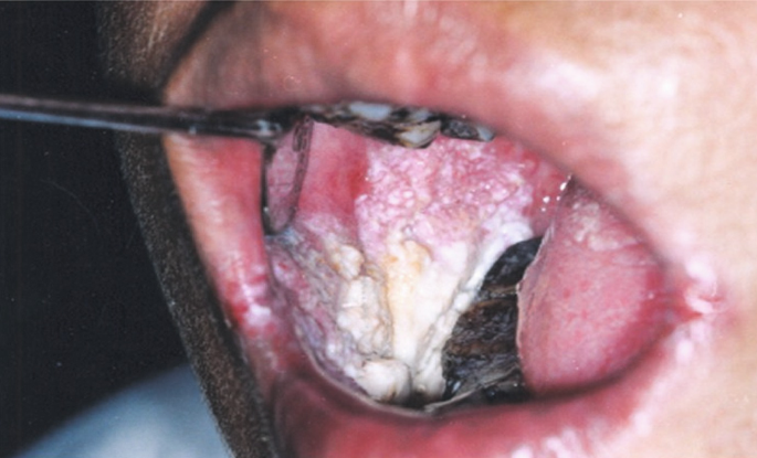 Smokeless Tobacco and Oral Health