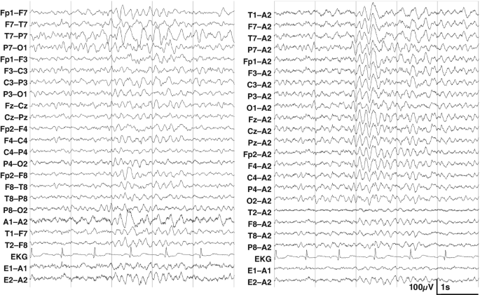 Eeg Pattern Example Printable Graph Focal Lesions | Springer Nature Link
