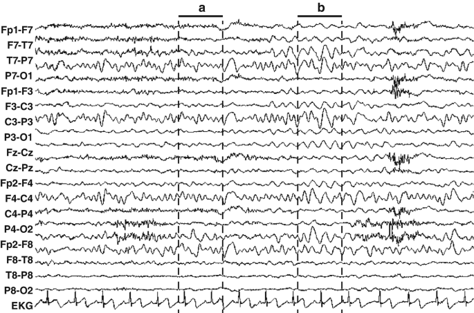 Normal Waking Electroencephalogram | SpringerLink