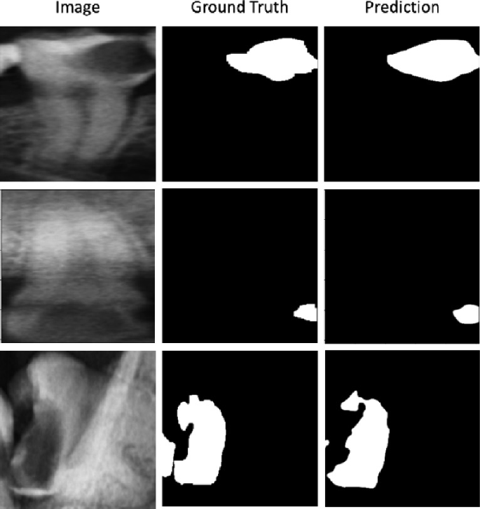 Automated Dental Caries Segmentation in Panoramic Radiographs Using ...