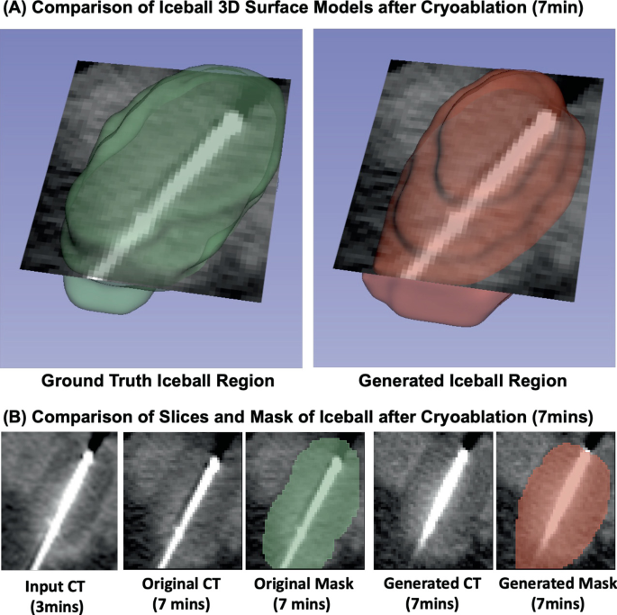 CryoFlow: Prediction of Frozen Region Growth in Kidney Cryoablation ...