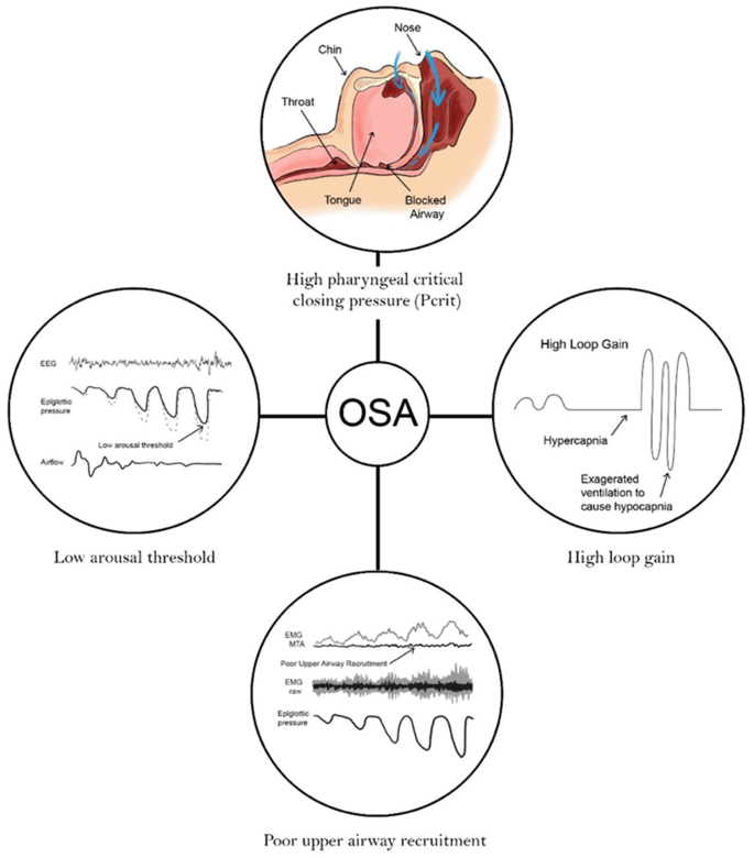 OSA Pathogenesis—The Hypotonic Phenotype | Springer Nature Link