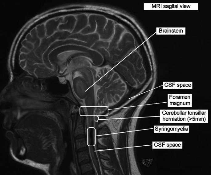 Headache Attributed to Chiari Malformation Type I (CM1) | Springer ...