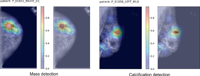 A Fully Automatic Patch-Based Deep Learning Pipeline for Mass and ...