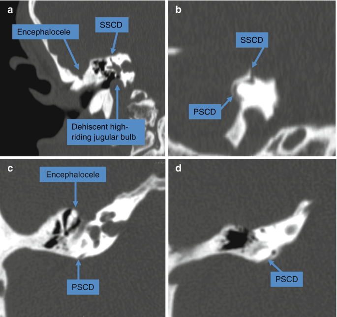 Miscellaneous Third Window Syndromes | Springer Nature Link