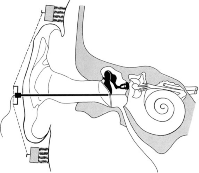 Electrocochleography | Springer Nature Link