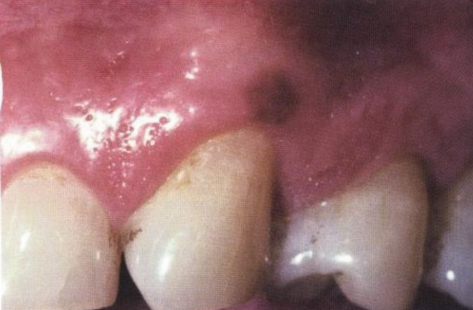 melanotic macules on gums Pigmented Lesions