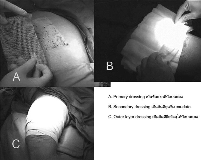 Wound Dressings: Principles and Modern Applications | Springer Nature Link