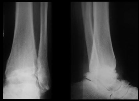 Extra-Caliber (carbon fiber) Radiolucent Tibia/Ankle System