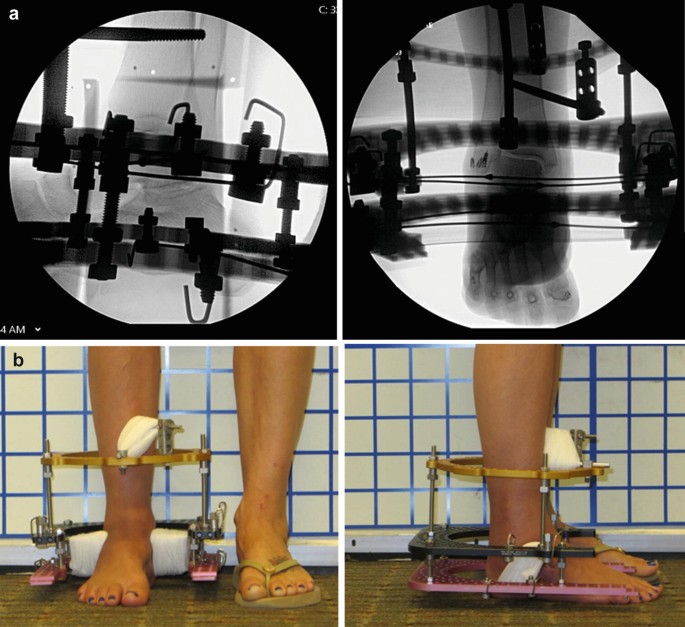 Subtalar Joint Distraction Arthroplasty | SpringerLink