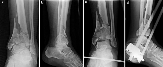 Primary Ankle Arthrodesis for Severe Tibial Pilon Fracture with ...