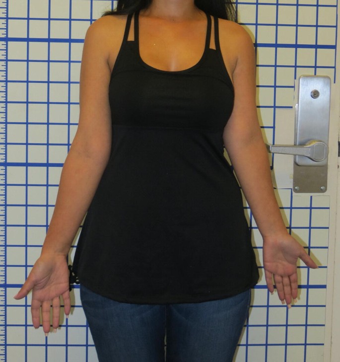 Humerus Lengthening with an Internal Lengthening Nail SpringerLink