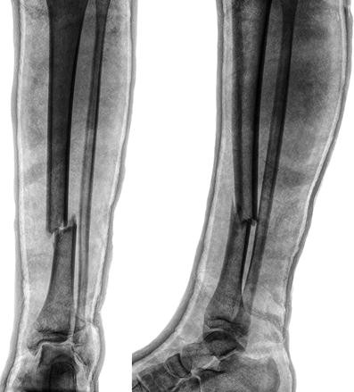 Circular external fixator application for midshaft tibial