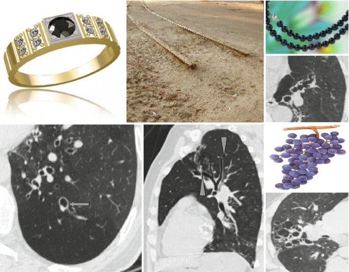 Signet ring cell “lymphoma”: mimicking the appearance of signet ring cell  carcinoma | International Journal of Hematology