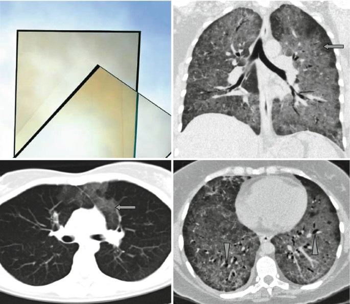 Ground-Glass Opacity and Black Bronchus Sign | SpringerLink