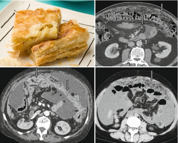 Omental Cakes: Unusual Aetiologies and CT Appearances Share Your Story