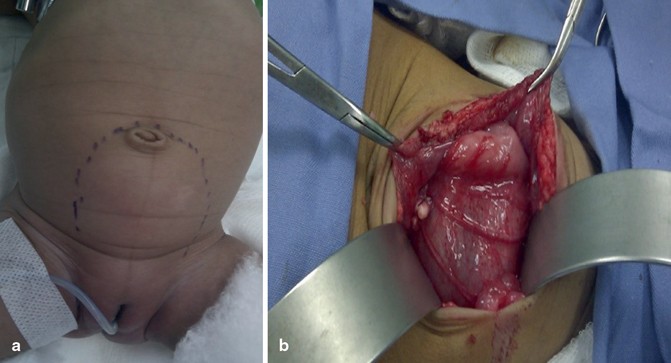 Teratoma | SpringerLink Teratoma | SpringerLink