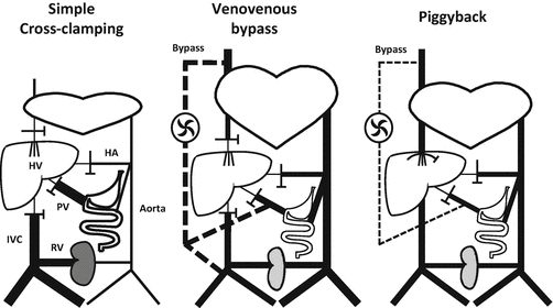 Anesthesia Management of Liver Transplantation | SpringerLink