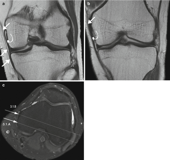 Medial Collateral Ligament (MCL) and Medial Supporting Structures |  SpringerLink