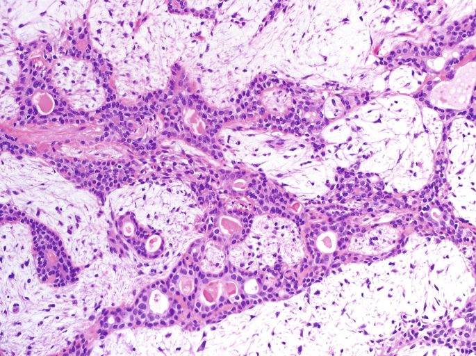 pleomorphic adenoma pathology