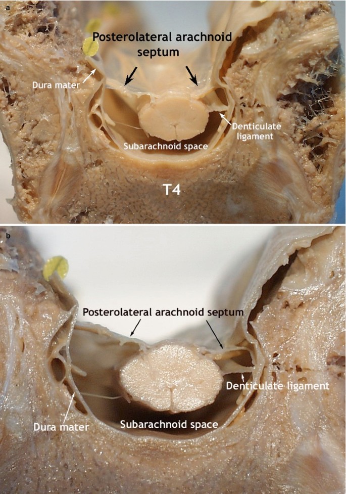 Subarachnoid (Intrathecal) Ligaments | SpringerLink