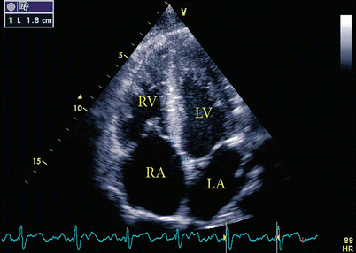 Ebstein's Anomaly with Moderate Tricuspid Regurgitation, Mild Septal  Displacement Ratio, and Grade 1 Right Atrial Cavity Ratio | SpringerLink